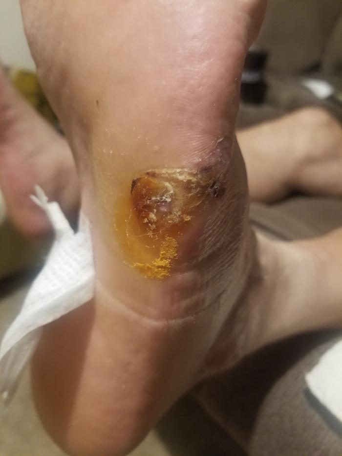 the sore