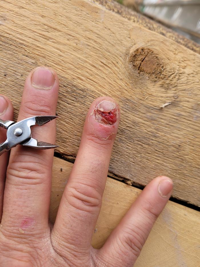 finger nail surgery