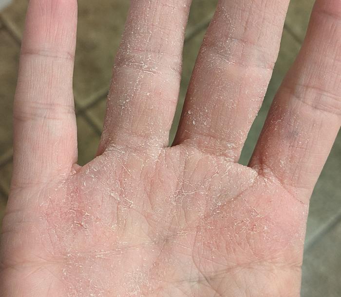 Eventually, my palm and multiple fingers were itchy, bumpy, and peeling