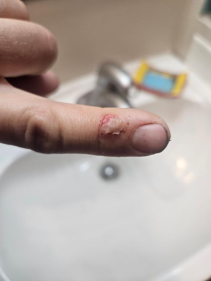 Lost my knuckle skin to hewing. It's taking a pretty physical toll on me