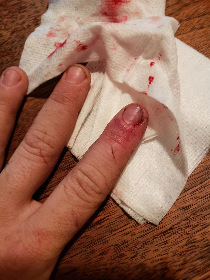Smashed finger