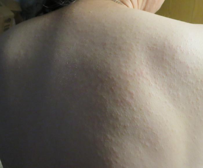 A very bumpy back. You can see the bumps end where my swimsuit line was.