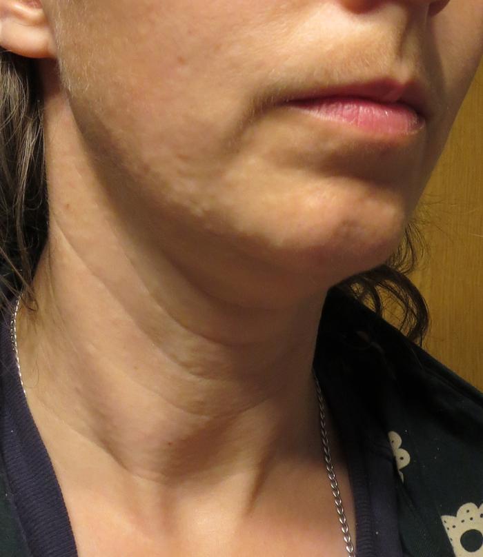 My face and neck are usually very smooth--not pitted and bumpy!