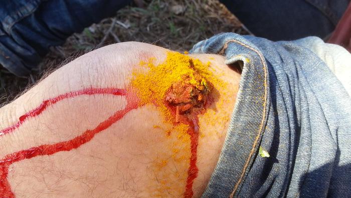 Kai's hatchet wound treated with yarrow and turmeric