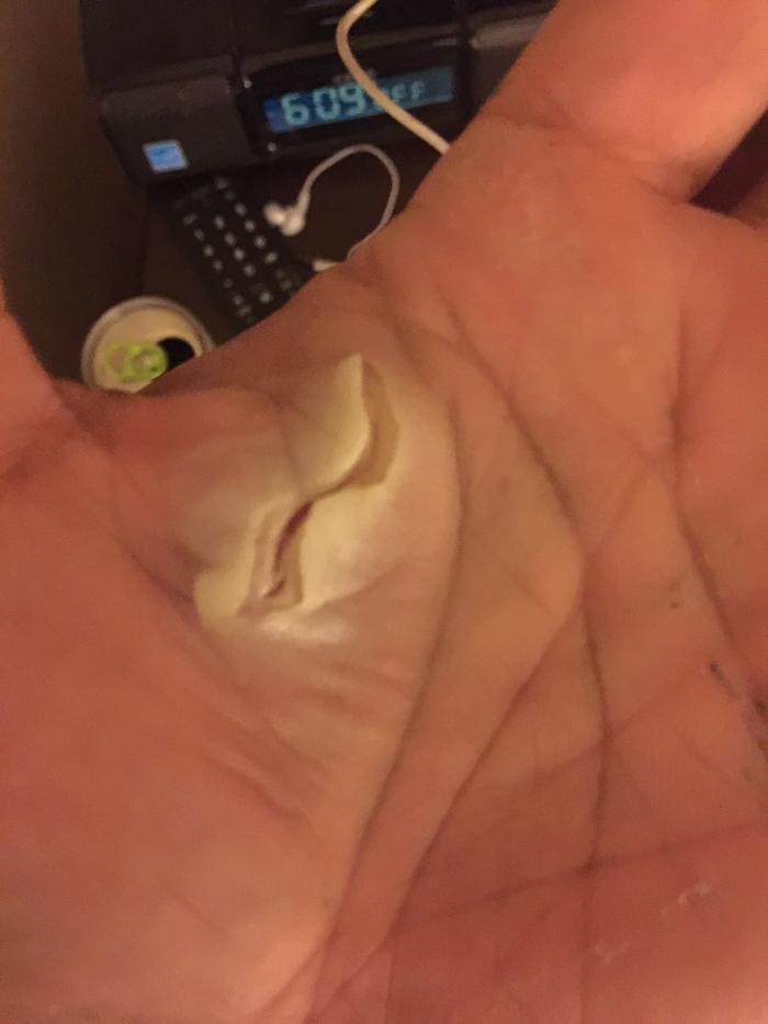 a dog bite that we treated with raw steak and raw honey and it healed in 2 weeks with no infection