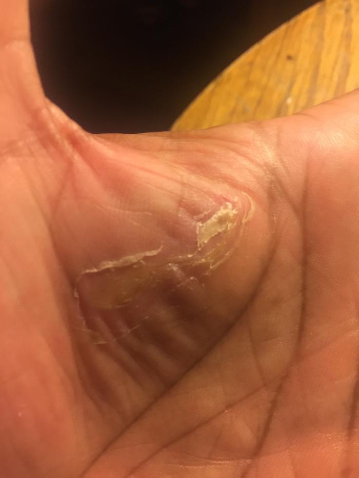 The steak cleaned out all the old blood out of the wound in 24 hours and it never got infected.
