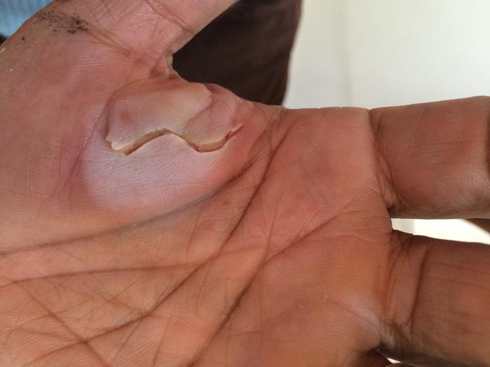dog bite