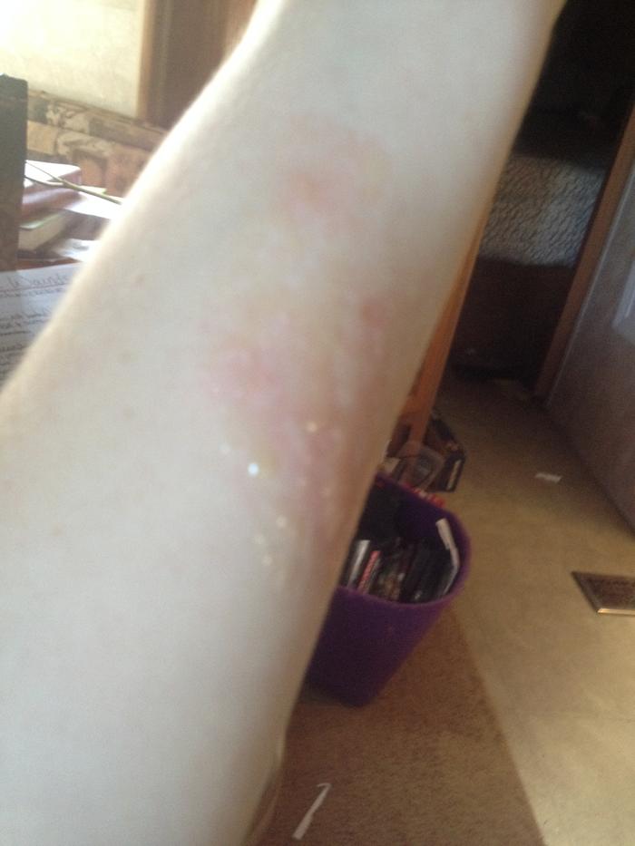 Poison Ivy Rash