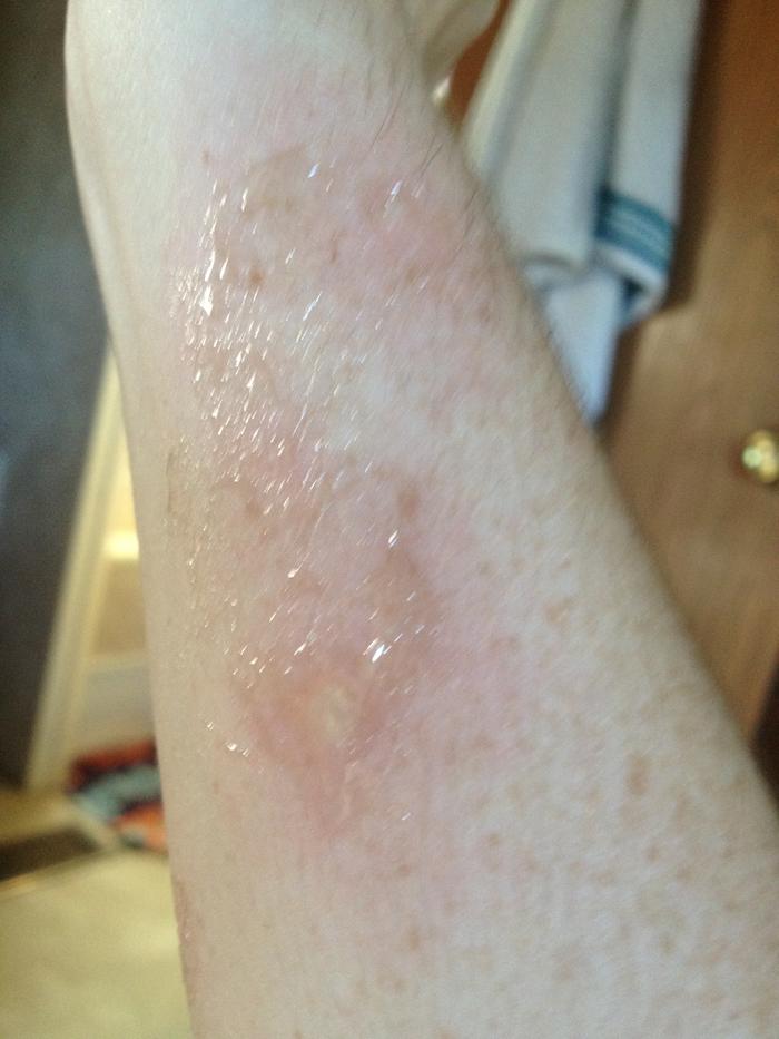Poison Ivy Rash