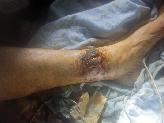 a human ankle with an infected bobcat bite