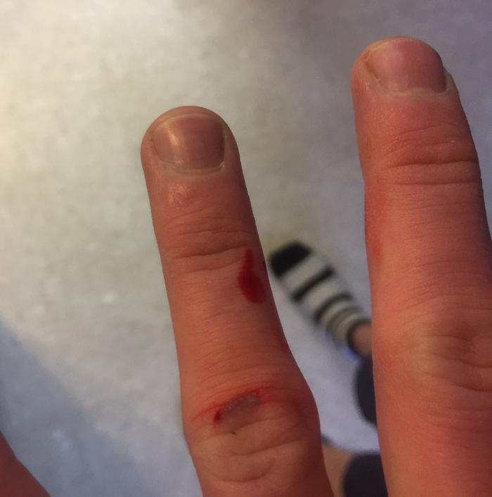 [Thumbnail for 12_cut_finger_01.jpg]